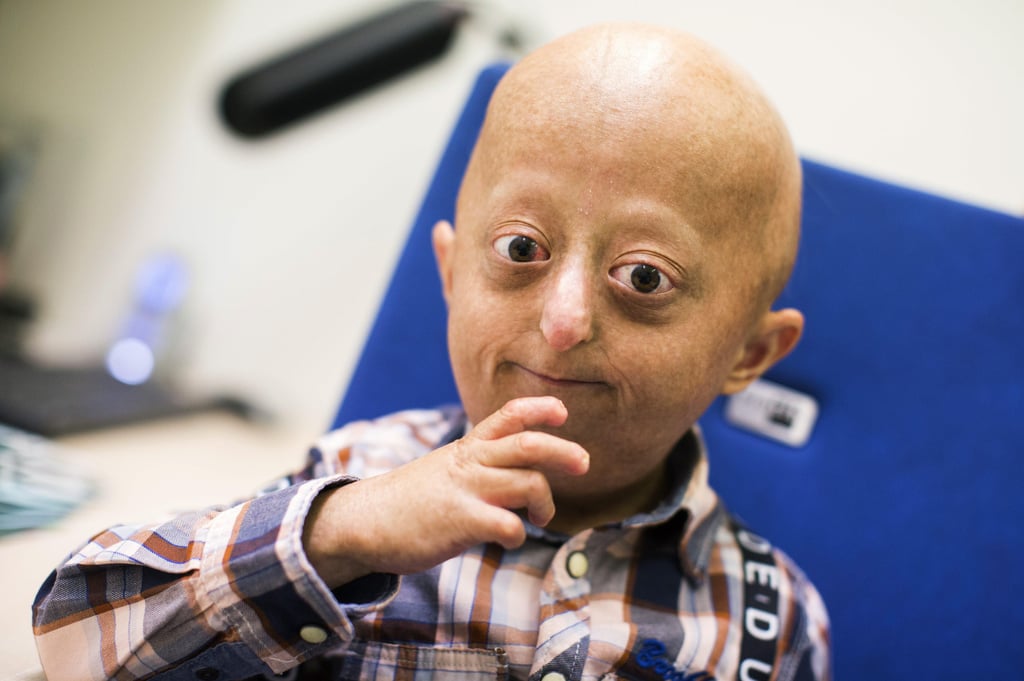 Der 15Jährige Yasin leidet an Frühvergreisung Ein Leben im Zeitraffer